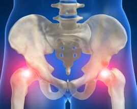Causes of hip arthritis