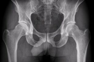 Options for diagnosing hip arthritis