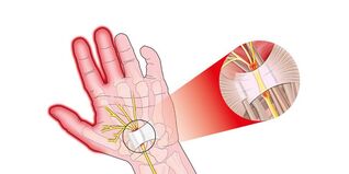 Finger joint pain in radiculopathy