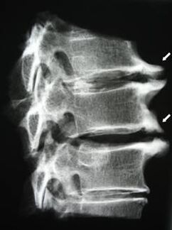 Cervical osteophytes cause neck pain