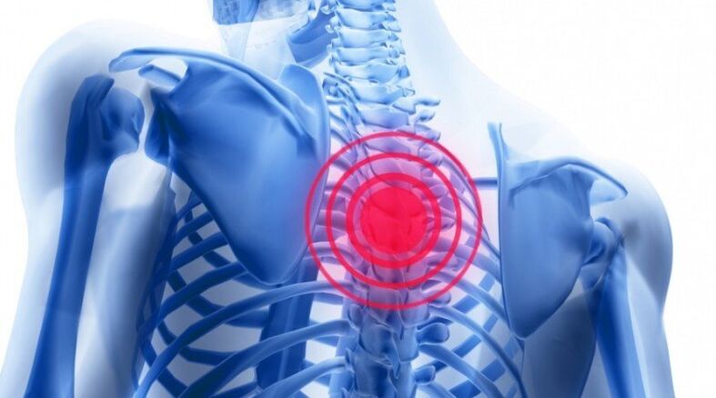 Back pain may be related to a herniated disc