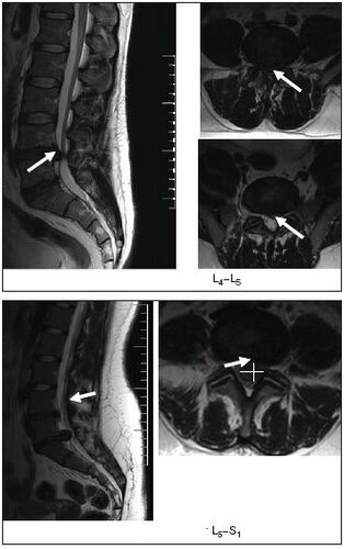 MRI scan of a herniated disc