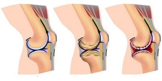 Pain when healthy joints and knee joints are destroyed