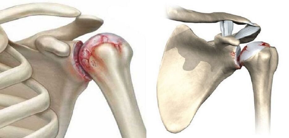 Shoulder joint damage and joints