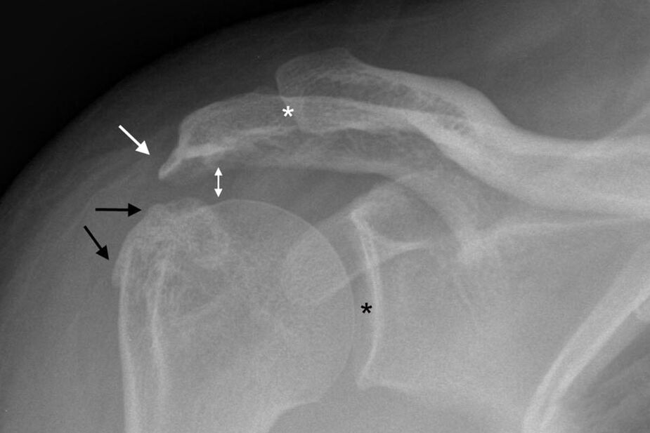 Shoulder joint disease on x-ray