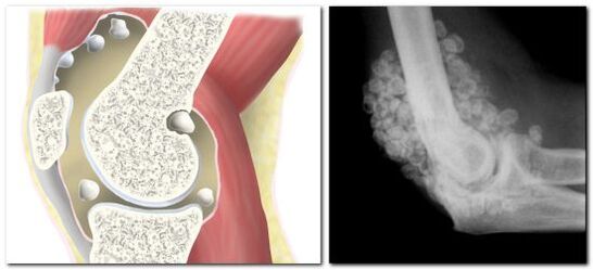 chondromatosis of hip pain