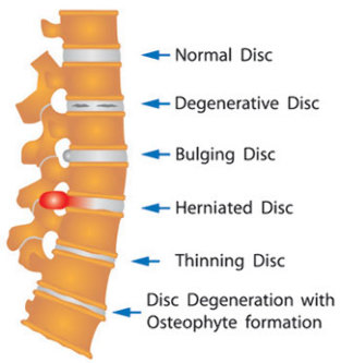 various disc damage in the spine
